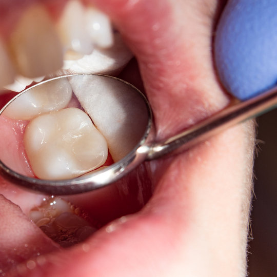 Core Build Up Composite