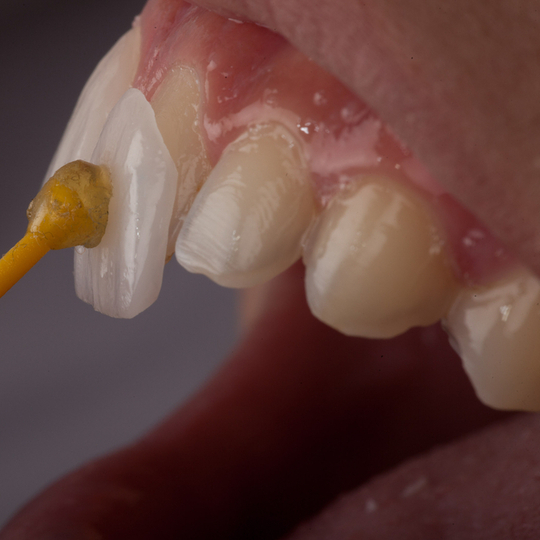 Labial Veneering Resin Komposit Direct